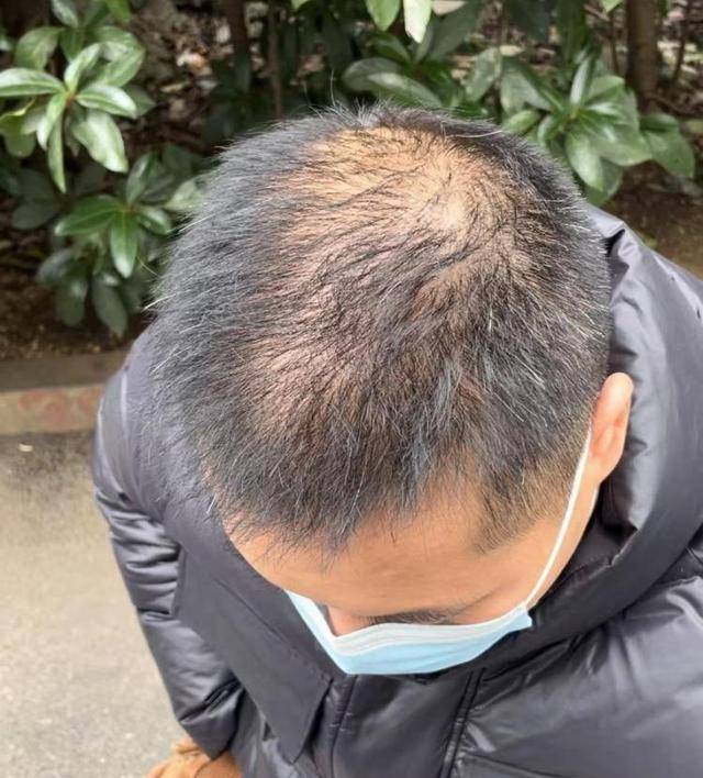 “还能反光<strong></p>
<p>雅视虚拟币</strong>！”长沙男子植发近9月称后脑勺“像狗啃过”