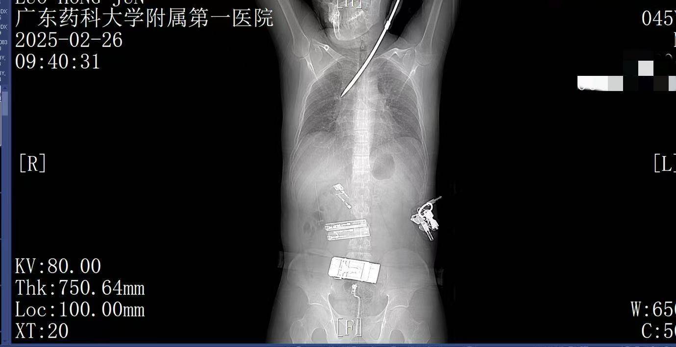 20米高空掉落螺丝刀直插男子胸腔<strong></p>
<p>区块链虚拟币</strong>！医生：不要自行拔除