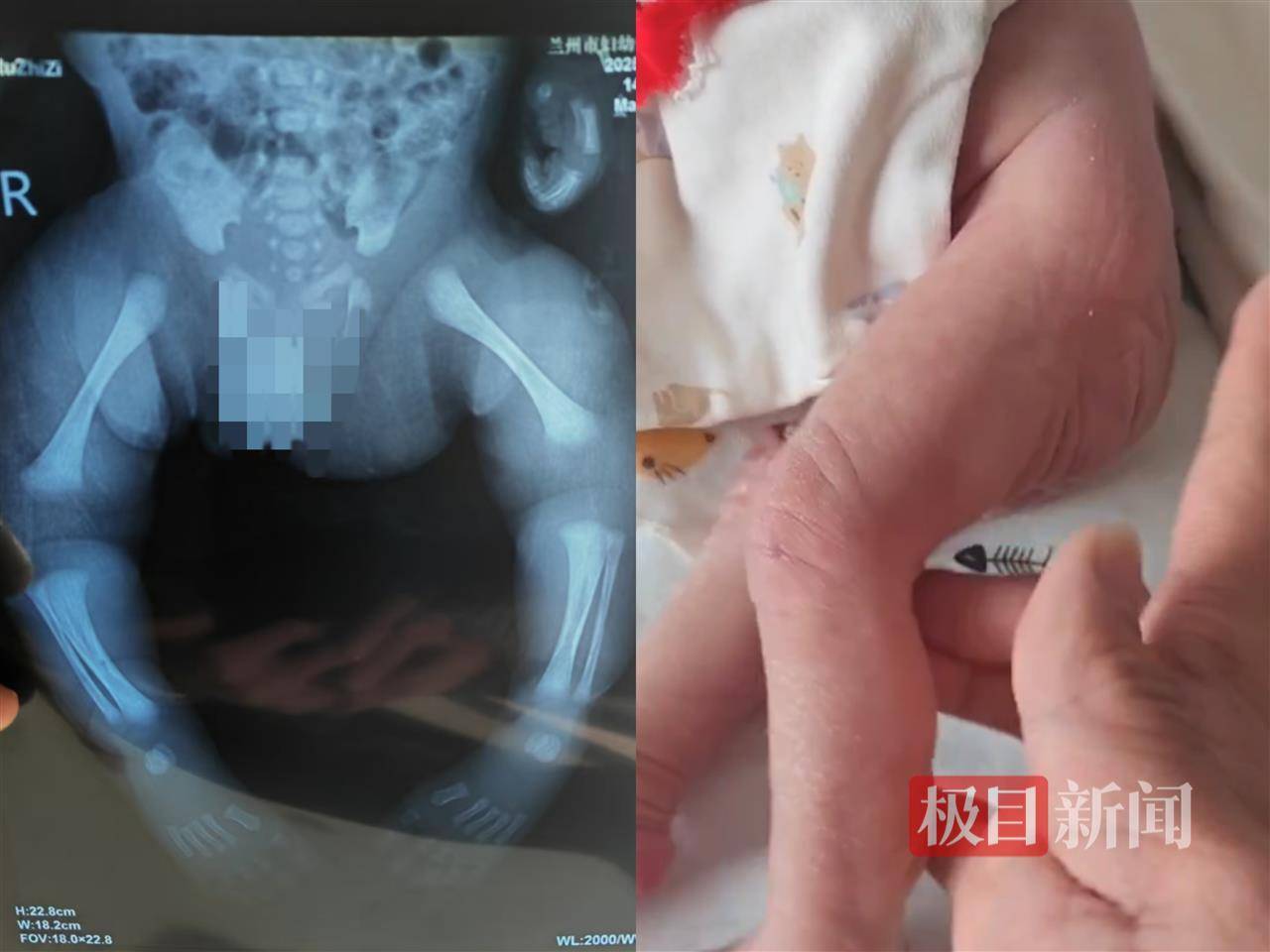 二胎出生查出先天性病症或落下残疾<strong></p>
<p>虚拟货币世界币</strong>，残疾父母称医院产检漏检、未尽告知义务，医院及医调委回应