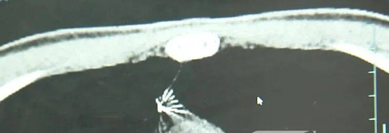 17岁小伙参军体检发现胸腔内有根5cm缝衣针<strong></p>
<p>梅雁吉祥股票</strong>,父母回忆或是1岁时扎入,取出时已锈迹斑斑