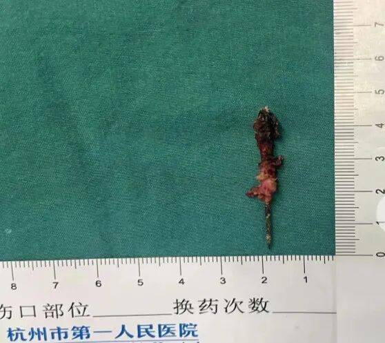 17岁小伙参军体检发现胸腔内有根5cm缝衣针<strong></p>
<p>梅雁吉祥股票</strong>,父母回忆或是1岁时扎入,取出时已锈迹斑斑