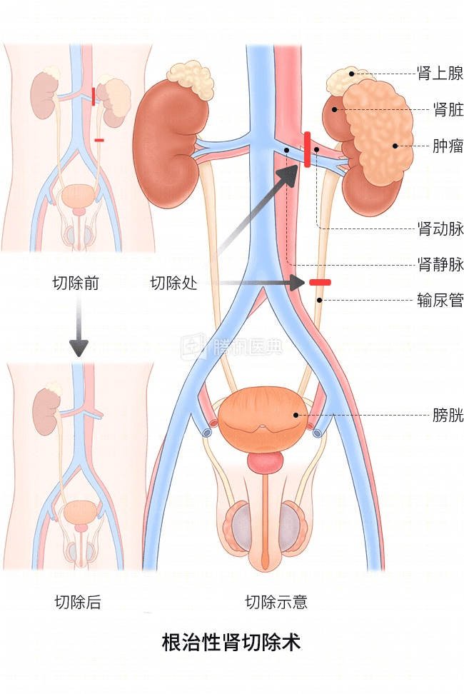 “感觉天塌了”！深圳女孩5岁患癌<strong></p>
<p>捷捷微电股票</strong>，爸妈决定：为她冻存卵巢组织